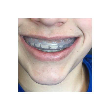 Mouth Guard